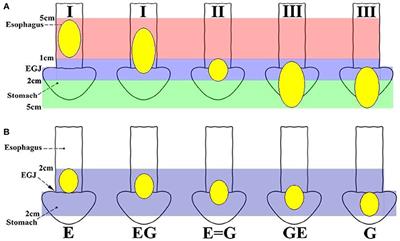 Optimal Extent of Transhiatal Gastrectomy and Lymphadenectomy for the Stomach-Predominant Adenocarcinoma of Esophagogastric Junction: Retrospective Single-Institution Study in China